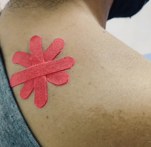 Kinesiotape aplicado sobre el hombro y la parte alta de la espalda de un paciente